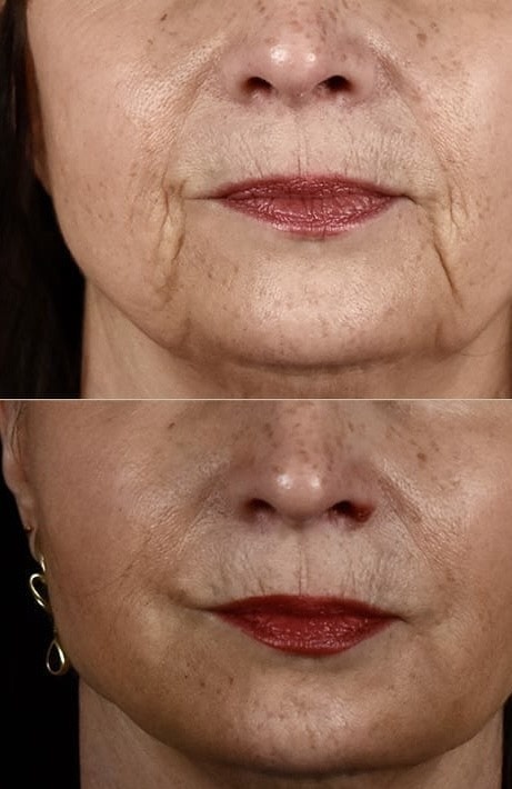 Remove Wrinkles by Fillers